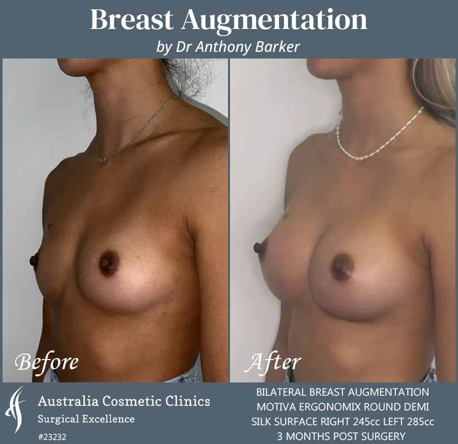 Breast Augmentation Patient 23232 Right 45
