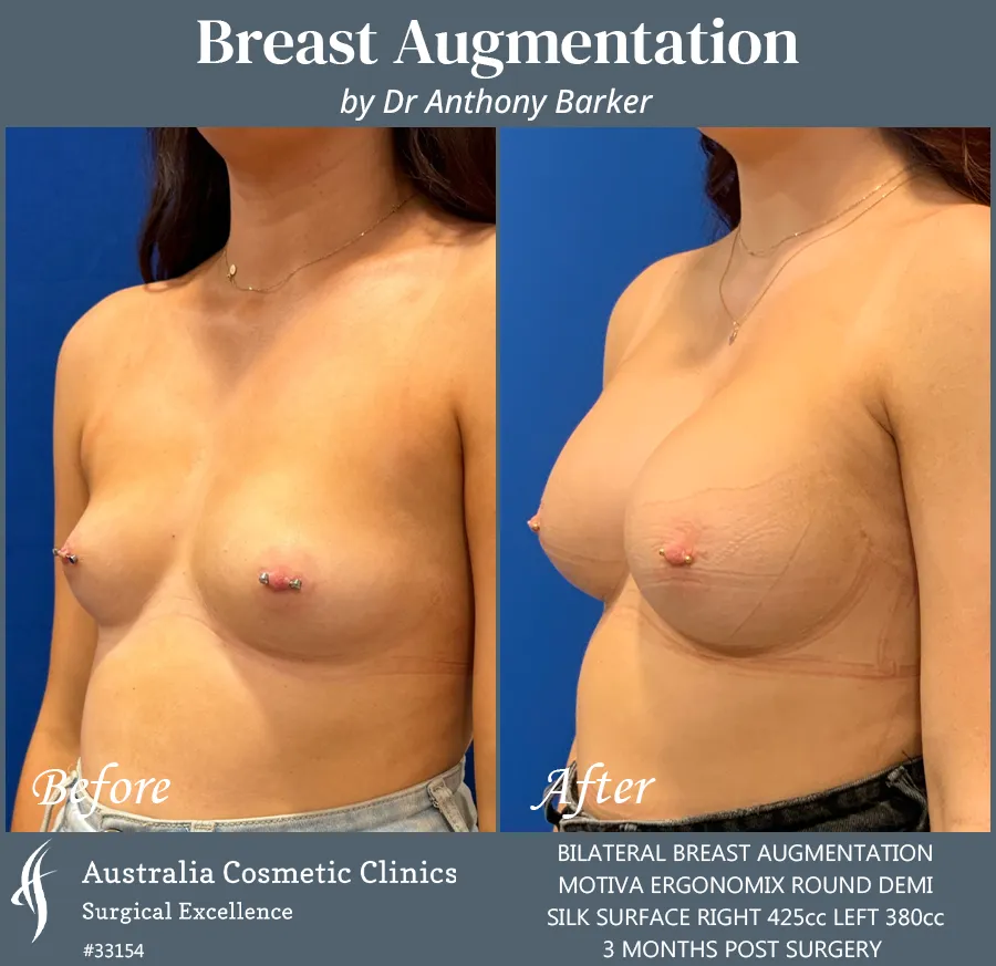 Breast Augmentation Patient 33154 45