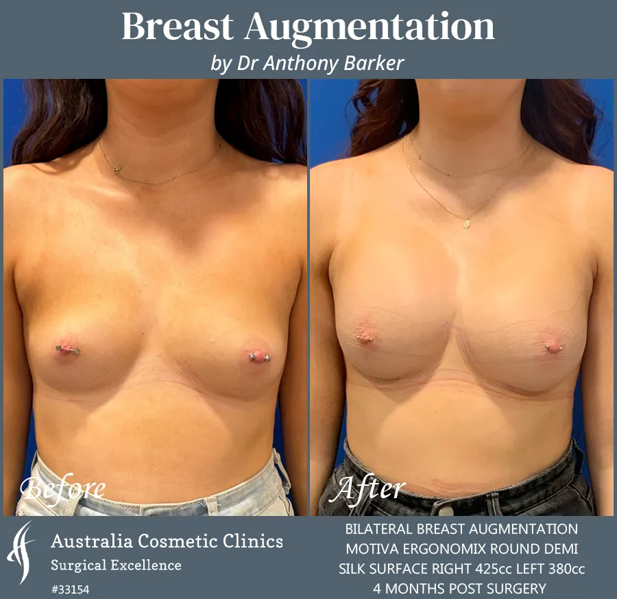 Breast Augmentation Patient 33154 Front