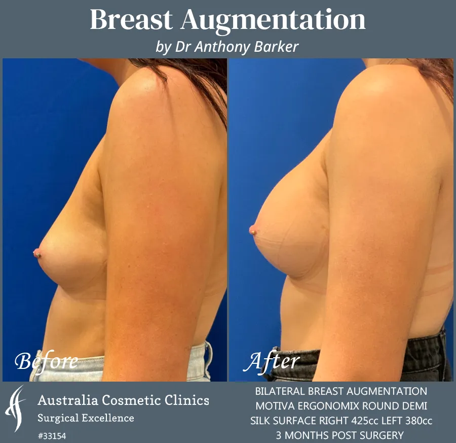 Breast Augmentation Patient 33154 Side