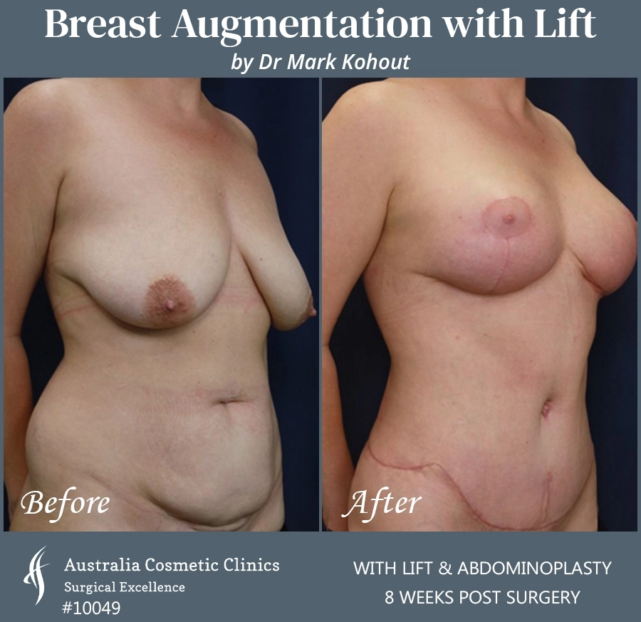 Breast Augmentation with Lift Patient 10049-45