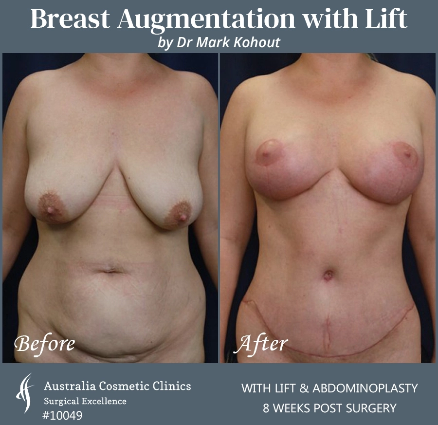 Breast Augmentation with Lift Patient 10049-FRONT