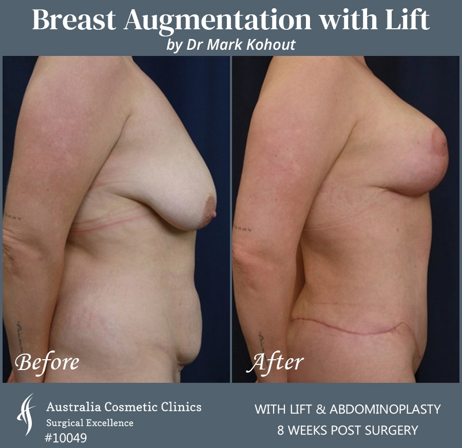 Breast Augmentation with Lift Patient 10049-SIDE