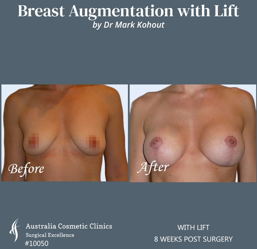 Breast Augmentation with Lift Patient 10050-FRONT