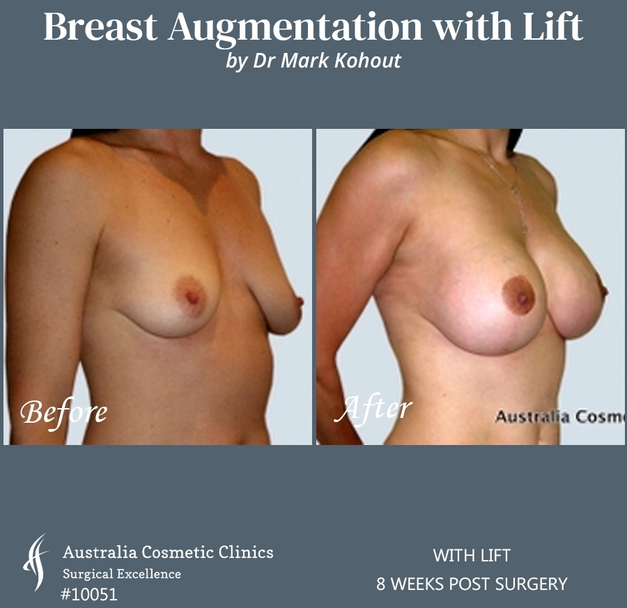 Breast Augmentation with Lift Patient 10051-45