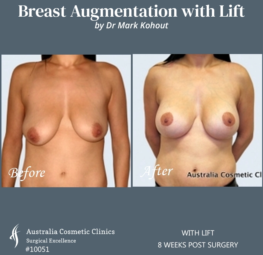 Breast Augmentation with Lift Patient 10051-FRONT
