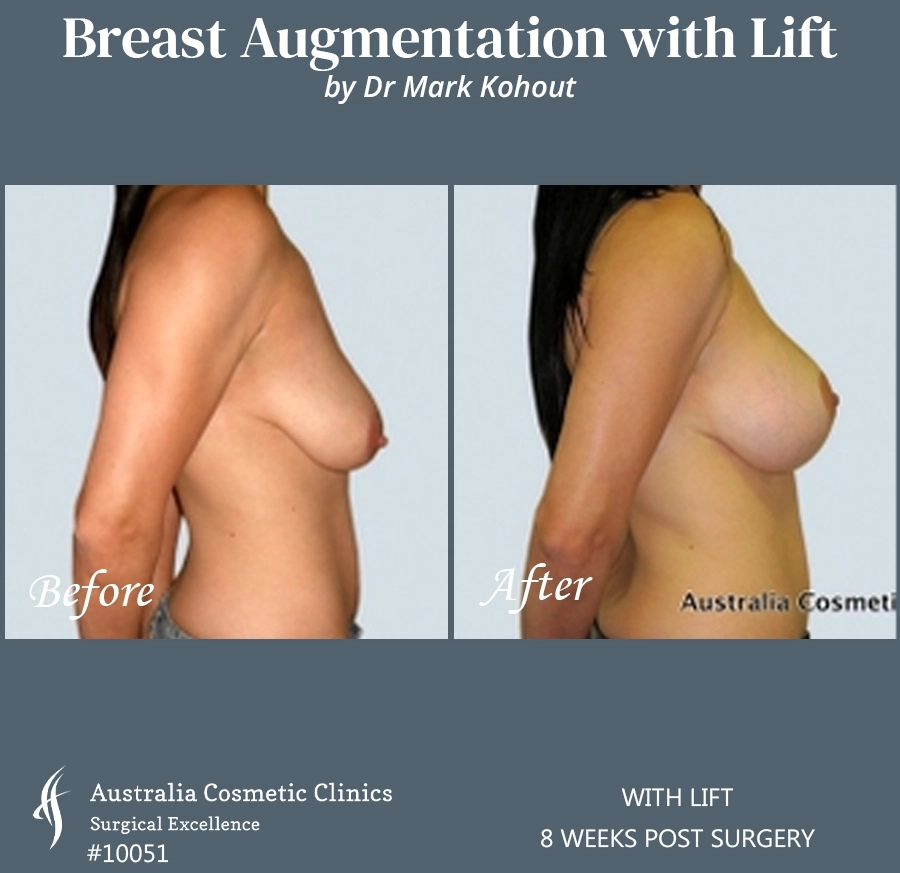 Breast Augmentation with Lift Patient 10051-SIDE