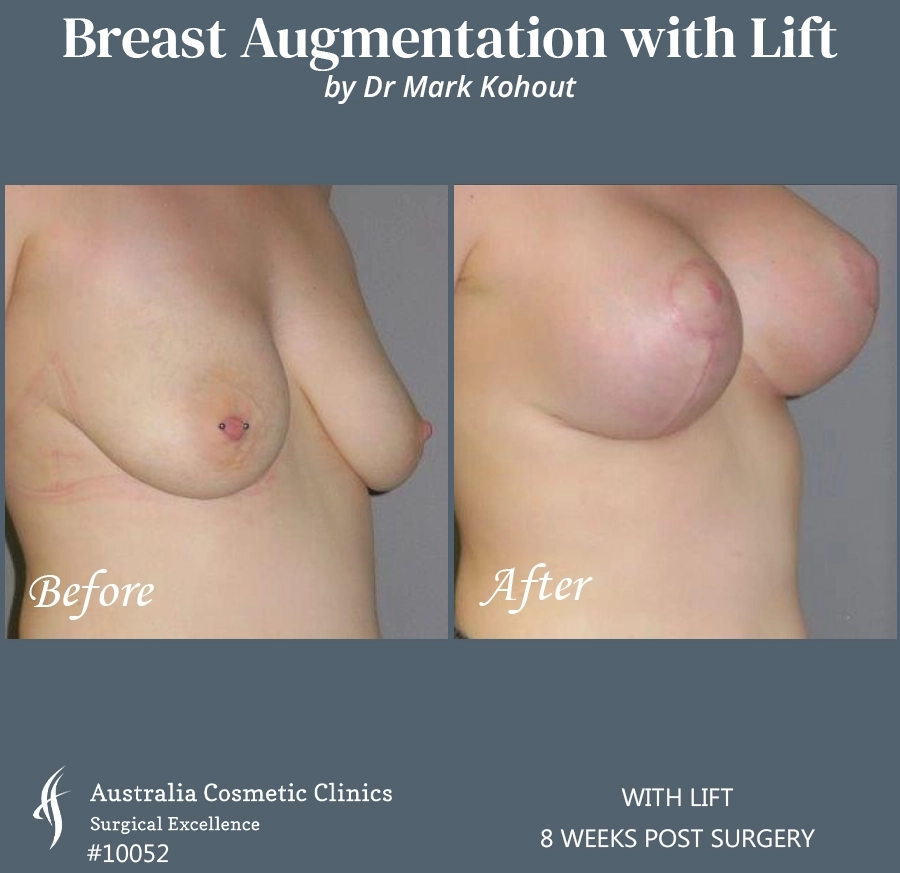 Breast Augmentation with Lift Patient 10052-45
