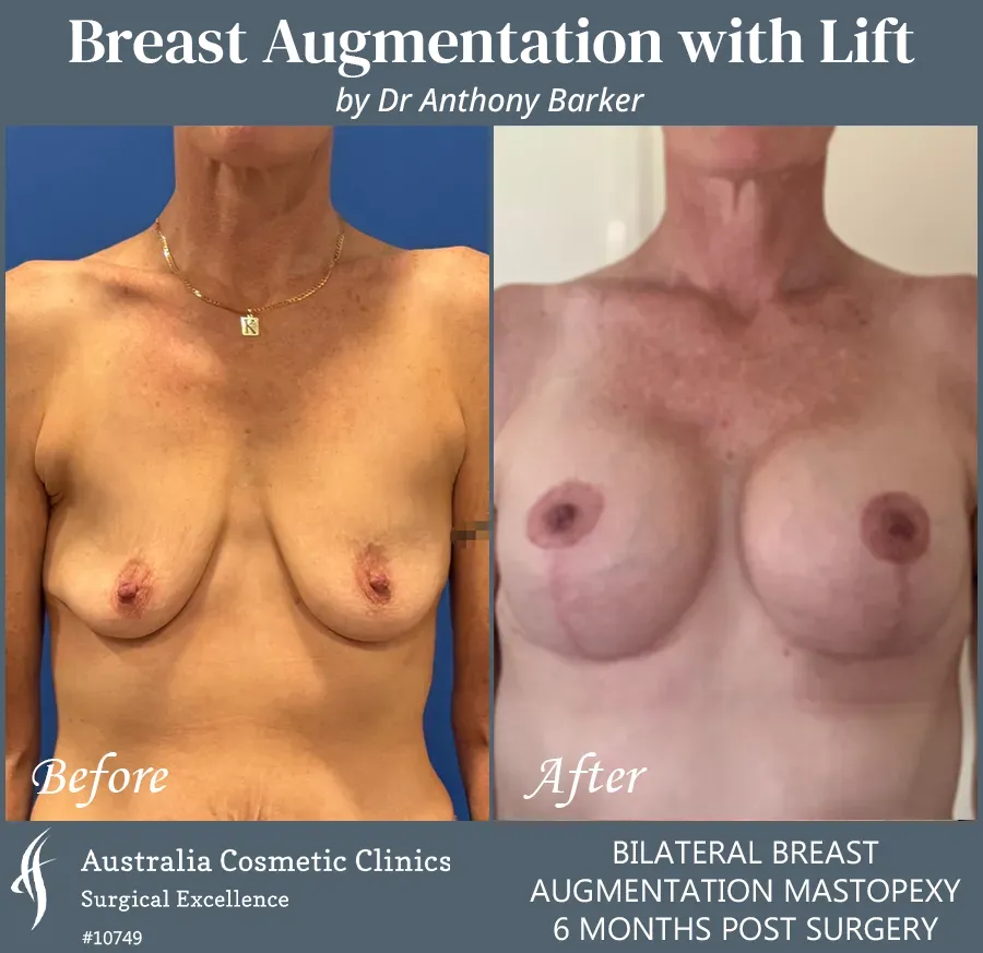 Breast Augmentation with Lift Patient 10749-Front