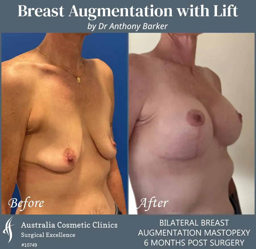 Breast Augmentation with Lift Patient 10749-L45