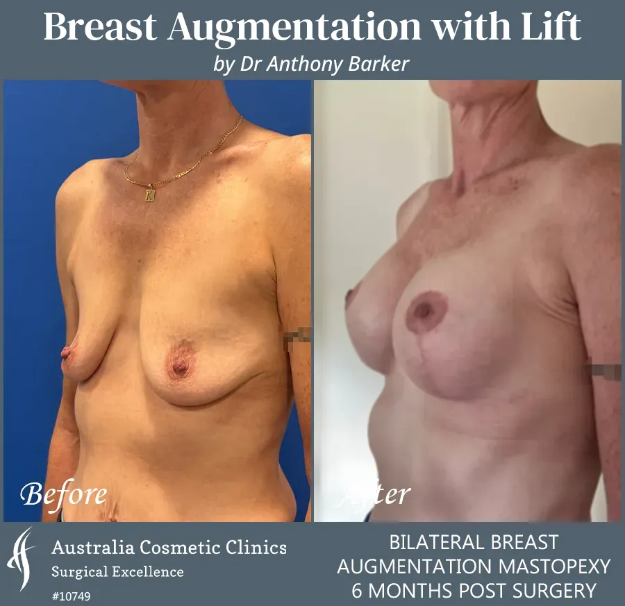 Breast Augmentation with Lift Patient 10749-R45