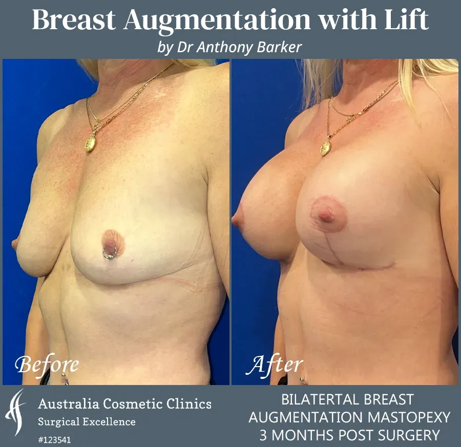 Breast Augmentation with Lift Patient 123541-45