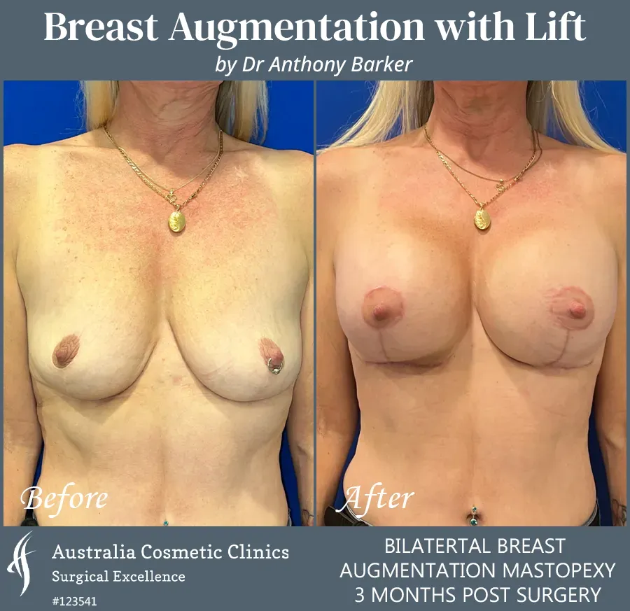 Breast Augmentation with Lift Patient 123541-Front