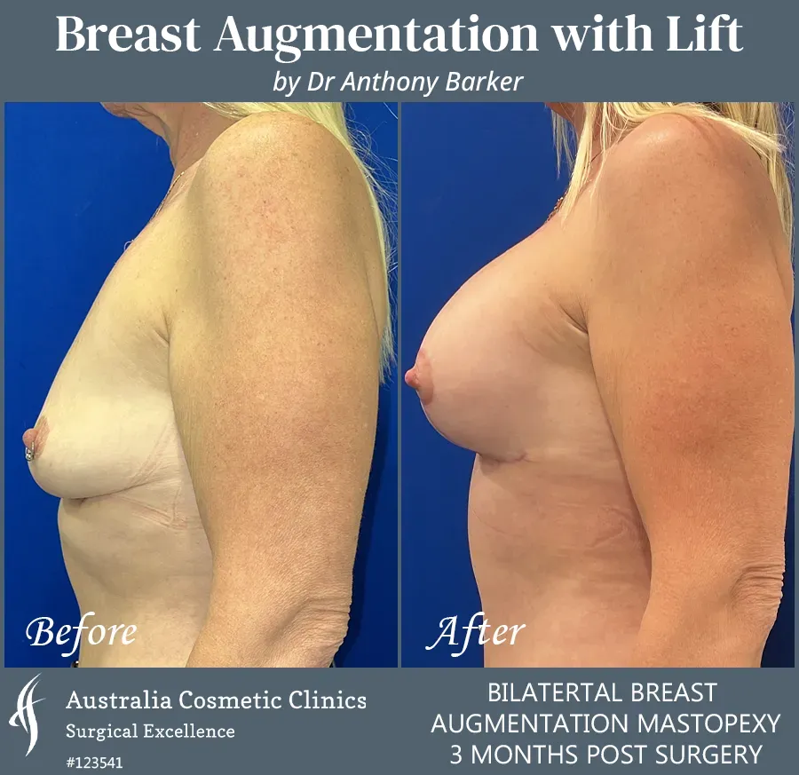 Breast Augmentation with Lift Patient 123541-Side