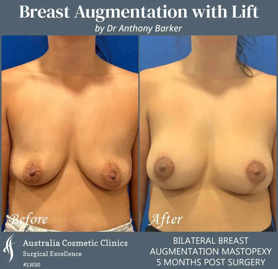 Breast Augmentation with Lift Patient 13030-Front