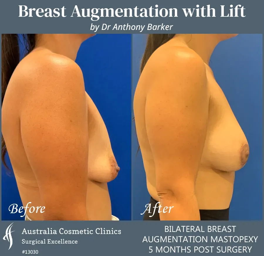 Breast Augmentation with Lift Patient 13030-Left Side