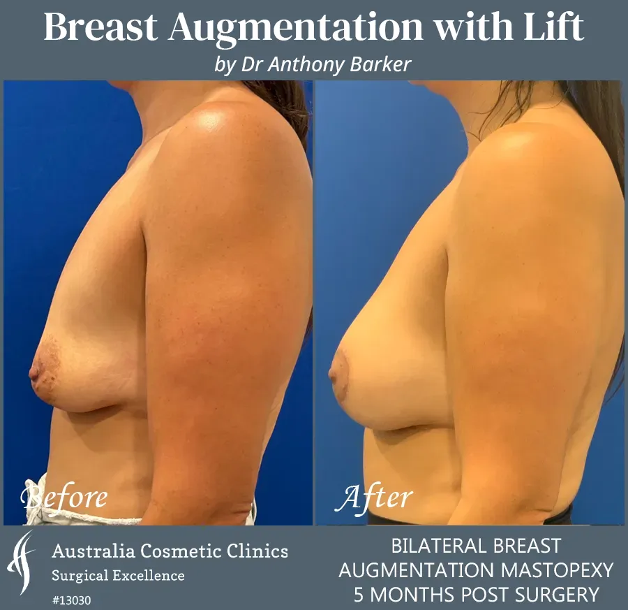 Breast Augmentation with Lift Patient 13030-Right Side