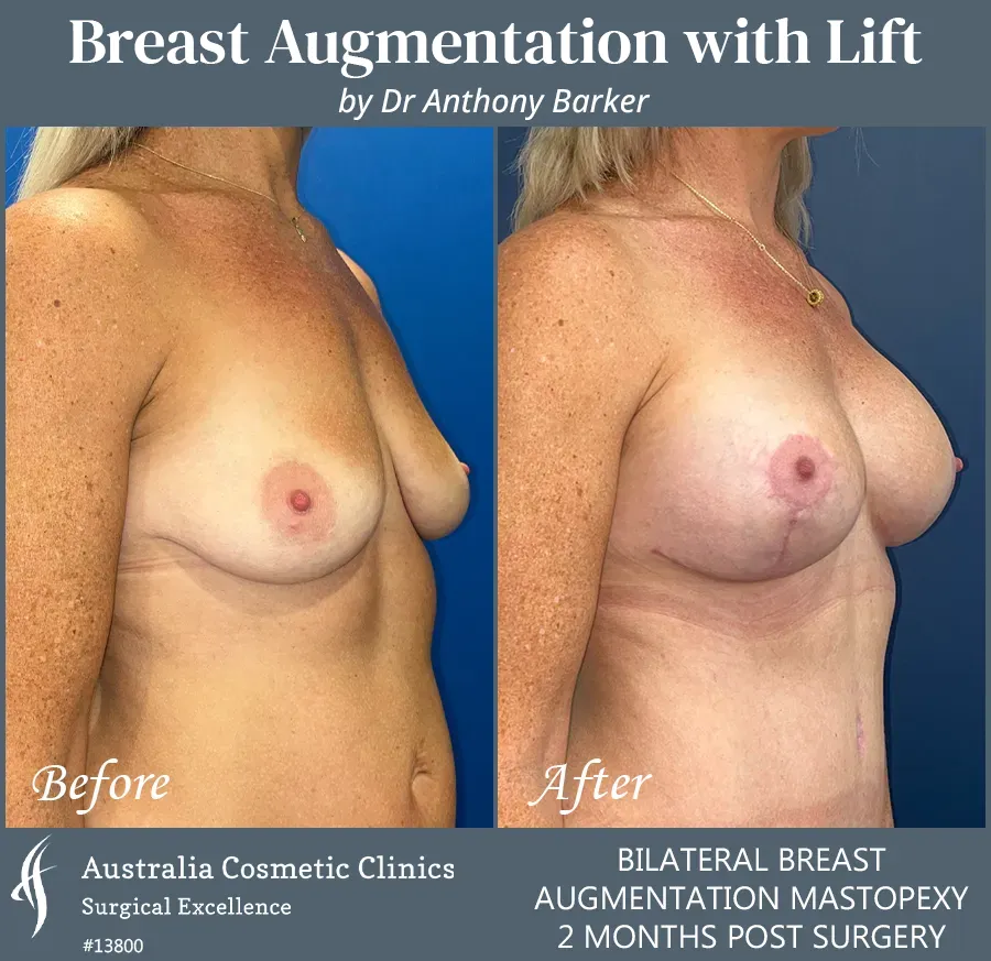 Breast Augmentation with Lift Patient 13800-45