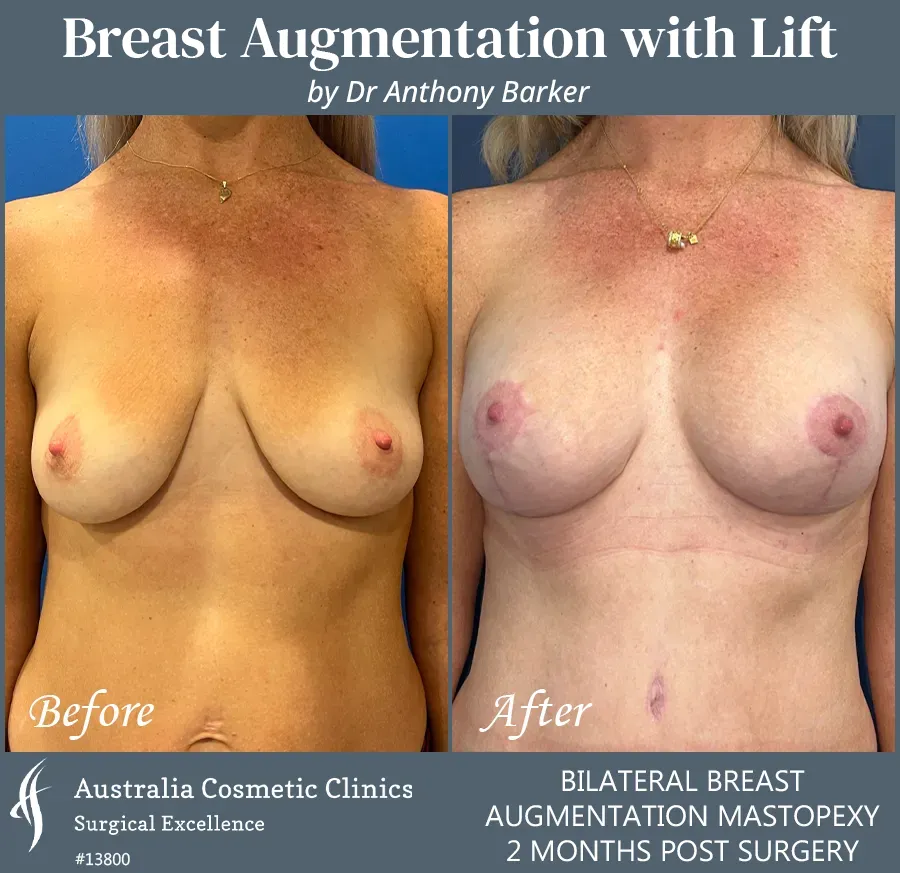 Breast Augmentation with Lift Patient 13800-Front