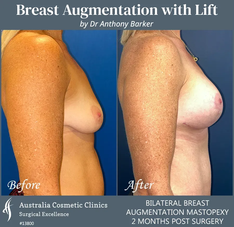 Breast Augmentation with Lift Patient 13800-Side