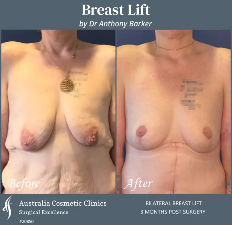 Breast Lift Patient 20850 Front