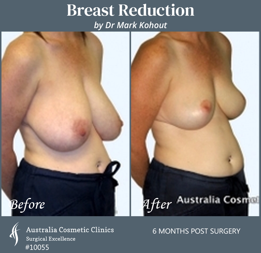 Breast Reduction Patient 10055 45