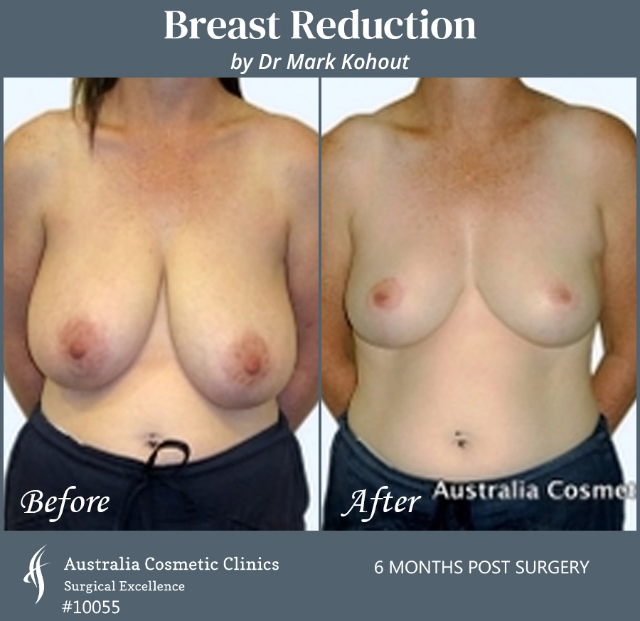 Breast Reduction Patient 10055 FRONT