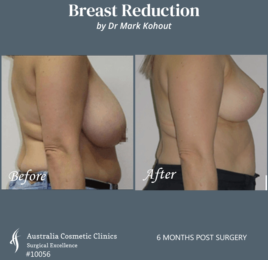 Breast Reduction Patient 10056 SIDE