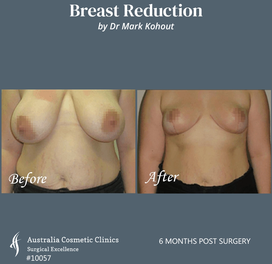 Breast Reduction Patient 10057 FRONT