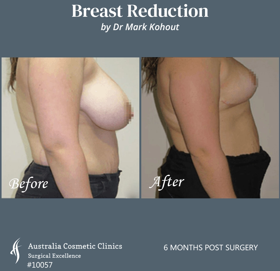 Breast Reduction Patient 10057 SIDE
