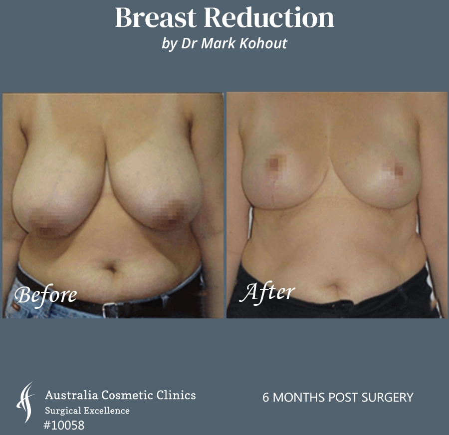 Breast Reduction Patient 10058 FRONT