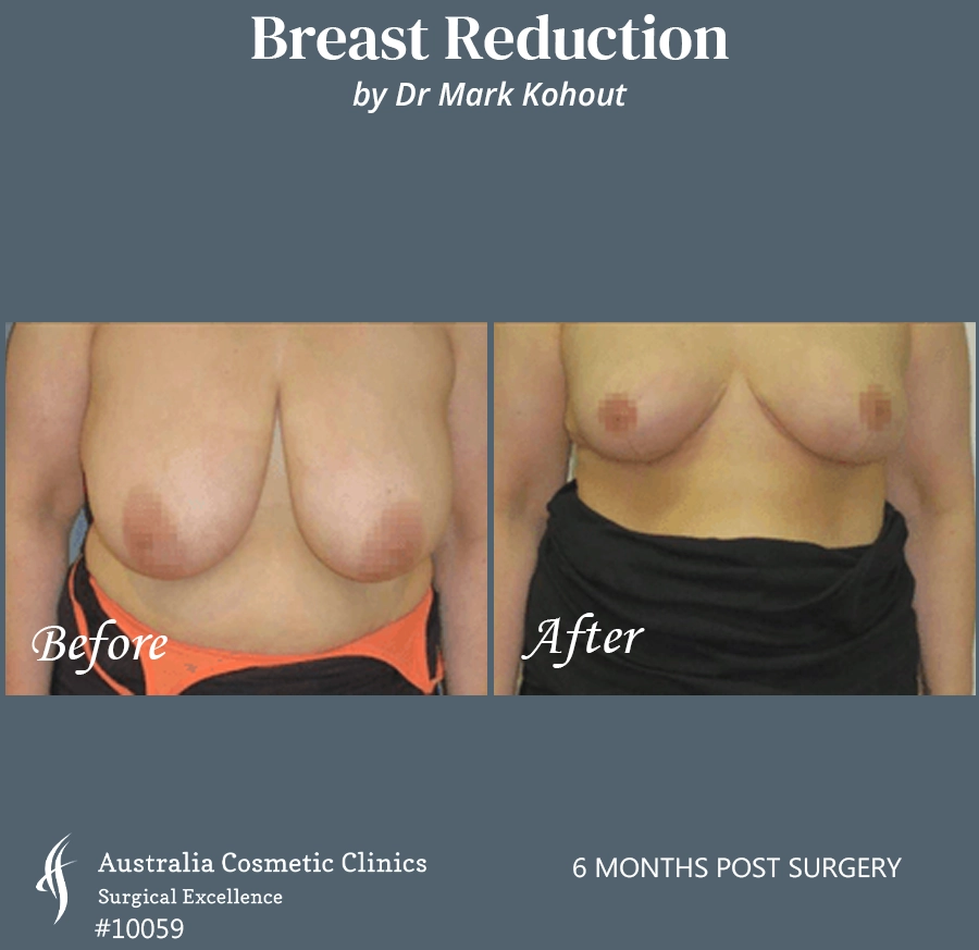 Breast Reduction Patient 10059 FRONT