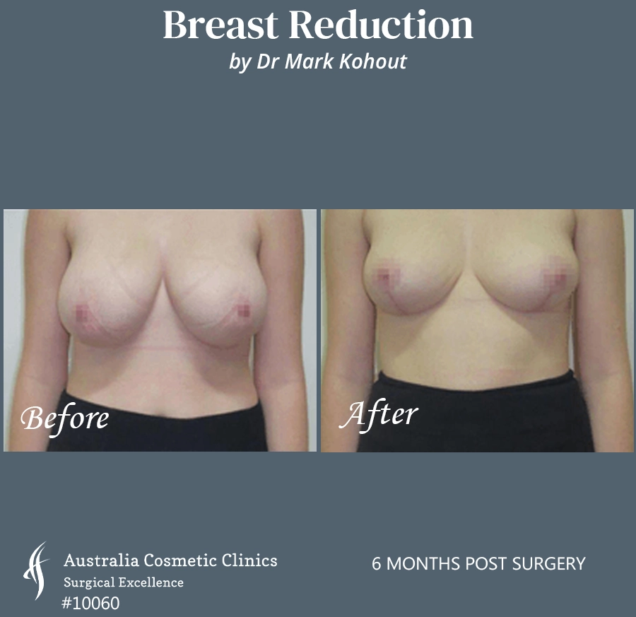Breast Reduction Patient 10060 FRONT