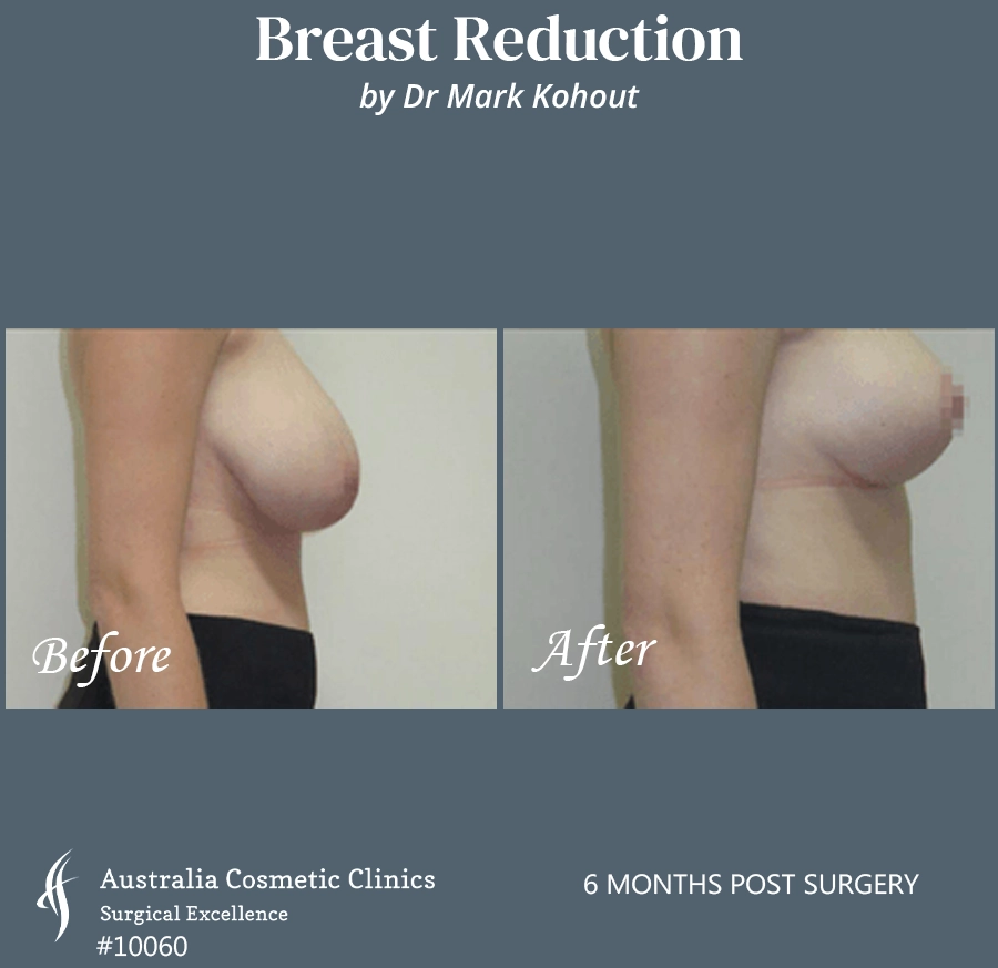 Breast Reduction Patient 10060 SIDE