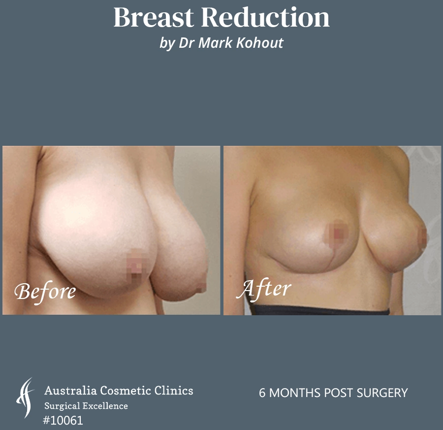 Breast Reduction Patient 10061 45