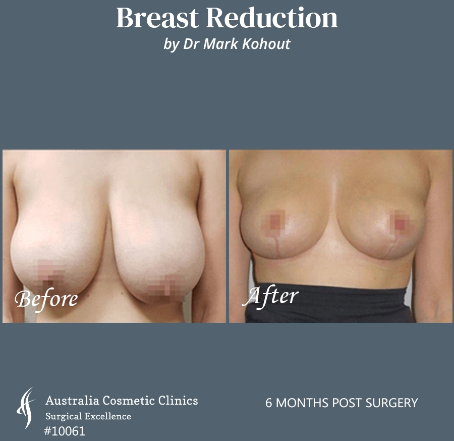 Breast Reduction Patient 10061 Front