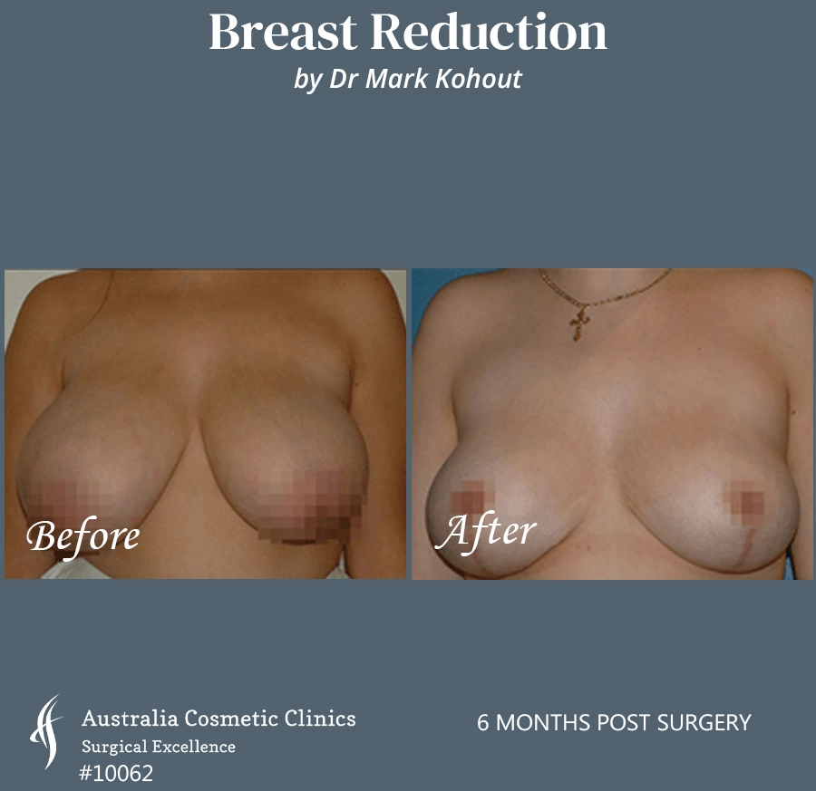 Breast Reduction Patient 10062 FRONT