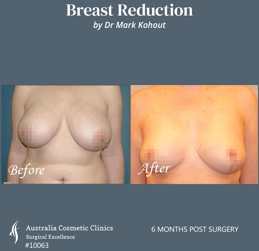 Breast Reduction Patient 10063 FRONT