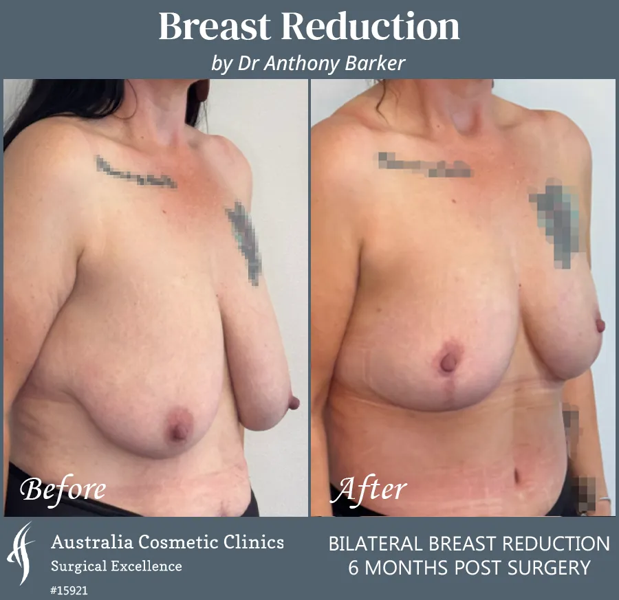 Breast Reduction Patient 15921 45