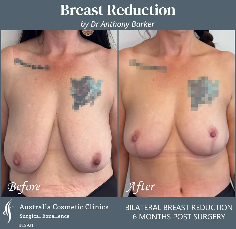 Breast Reduction Patient 15921 Front