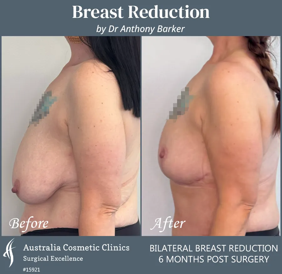 Breast Reduction Patient 15921 Side