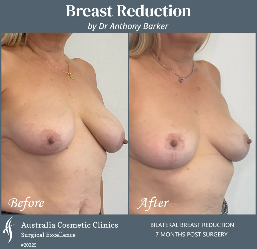 Breast Reduction Patient 20325 45