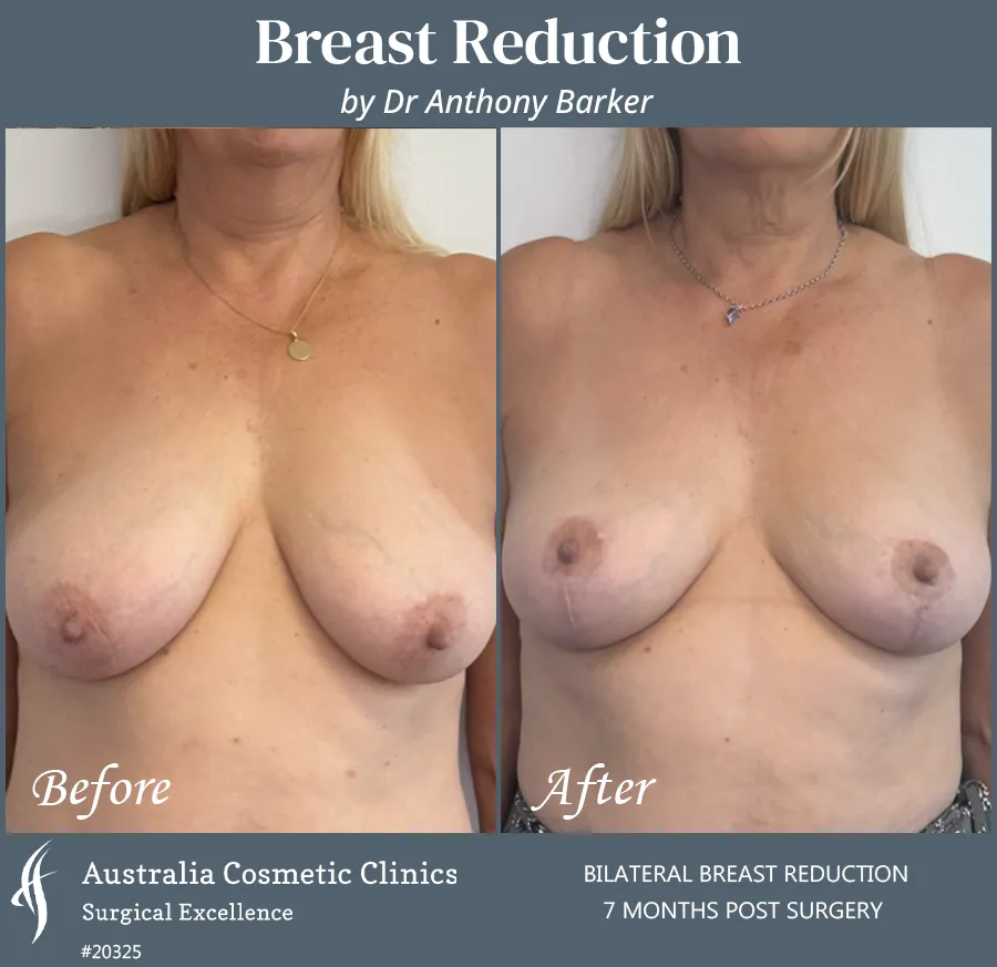 Breast Reduction Patient 20325 Front