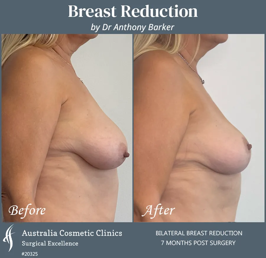 Breast Reduction Patient 20325 Side