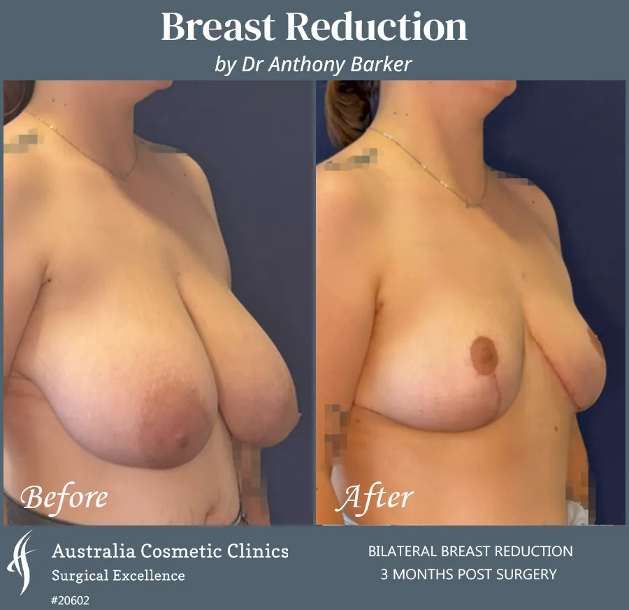 Breast Reduction Patient 20602 45