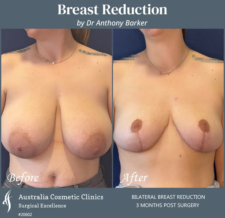 Breast Reduction Patient 20602 Front