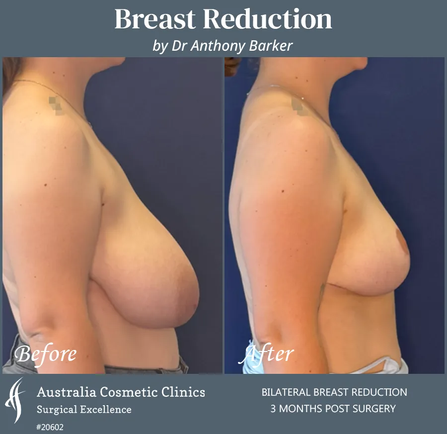 Breast Reduction Patient 20602 Side