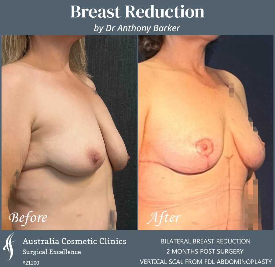 Breast Reduction Patient 21200 45