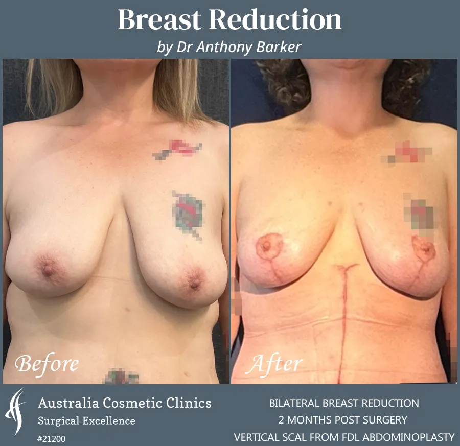 Breast Reduction Patient 21200 Front
