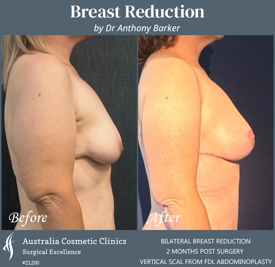 Breast Reduction Patient 21200 Side